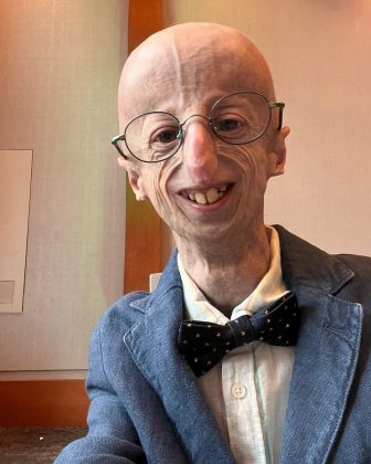 Sufría de una rara condición llamada progeria (Imagen: Instagram)